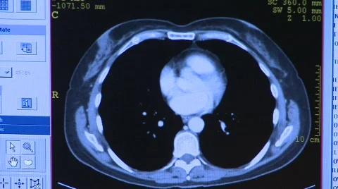 MRI screen - brain scan Stock Footage 693761