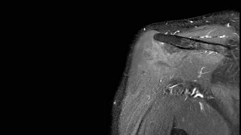 MRI Shouder3 Stock Footage 158902362