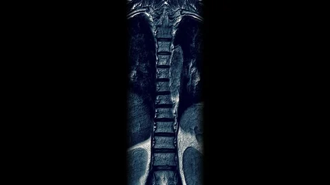MRI of the thoracic region, detection of protrusions and hernias on the spine Video stock 118264891