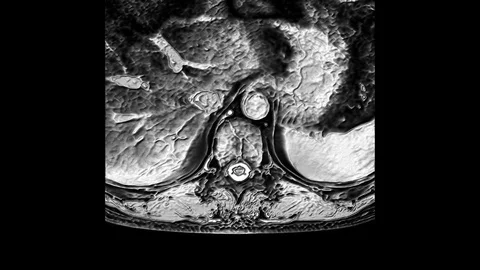 MRI of the thoracic region, detection of protrusions and hernias on the spine Stock Footage 119282348