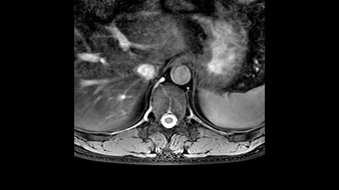 MRI of the thoracic region, detection of protrusions and hernias on the spine Stock Footage 119488396