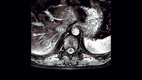 MRI of the thoracic region, detection of protrusions and hernias on the spine Stock Footage 119625072