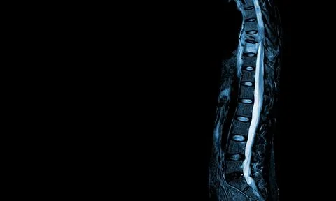 MRI of thoracic spine Moderate pathologic compression fracture of T9 verteb.. Stock Photos