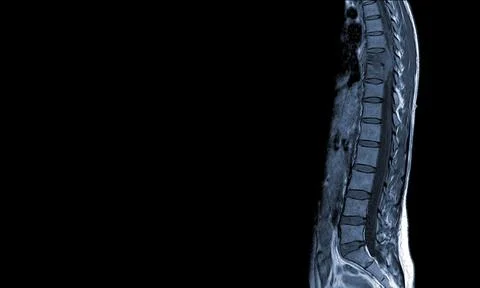 MRI of thoracic spine Moderate pathologic compression fracture of T9 verteb.. Stock Photos