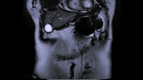 MRI upper abdomen  coronal T2. Stock Footage 105366988