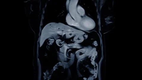 MRI of the upper abdomen coronal view is a non-invasive imaging technique p.. Stock Photos