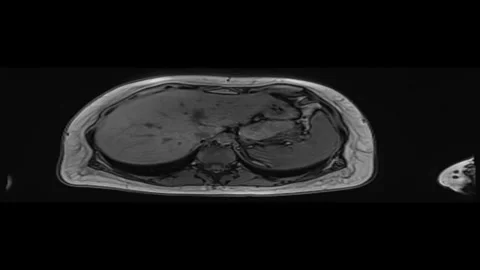 MRI video sequence for pancreas and pancreatitis evaluation, macro shot Stock Footage 292122838