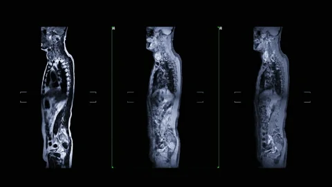 Mri whole spine Stock Footage 150818368