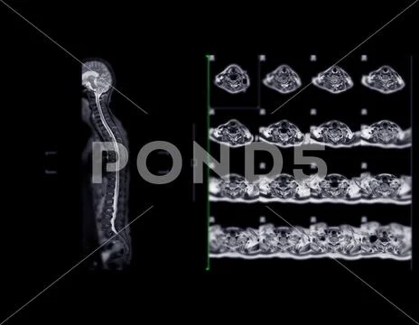 MRI whole spine screening for diagnosis spinal cord compression ...