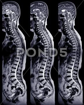 MRI whole spine screening for diagnosis spinal cord compression ...