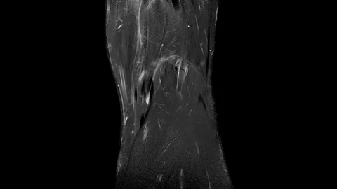 MRT KNEE 01 4K Vidéo 124781584