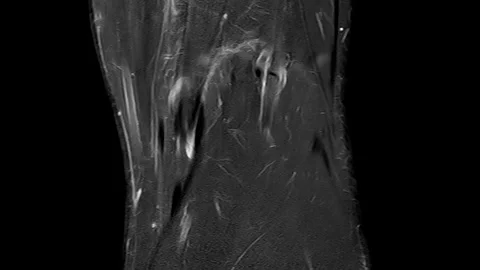 MRT KNEE 01 HD Vidéo 124780783