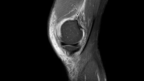 MRT KNEE 03 4K Vidéo 124781864