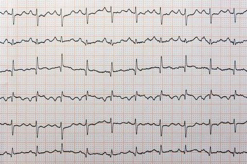 A multi-lead electrocardiogram (ECG) rhythm strip with a highly irregular, rapid Stock-Fotos