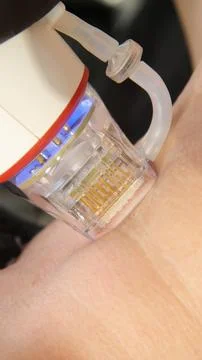 A multifunctional device for microneedle RF lifting. Aesthetic procedures f.. Fotos de archivo