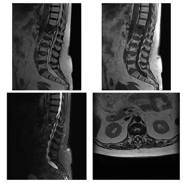Multiplanar MRI Panel of Lumbar Spine with T1 T2 STIR and Axial Views Stock Photos