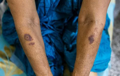 Multiple dark bruise marks or scars on a person's arms Stock Photos