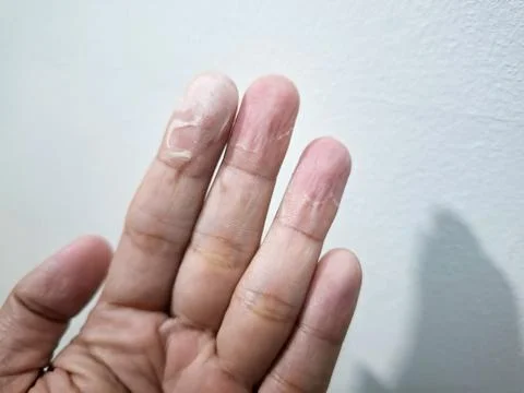 Multiple fingertips with peeling skin and redness showing signs of contact .. Stock Photos