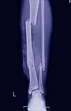 Multiple fracture leg tibia and fibular Stock Photos