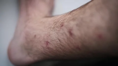 Multiple Insect Bites on Man's Legs Stock Footage 277298569