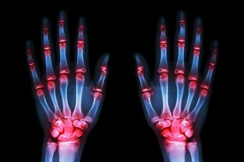 Multiple joint arthritis both hands ( gout , rheumatoid ) on black background Stock Photos