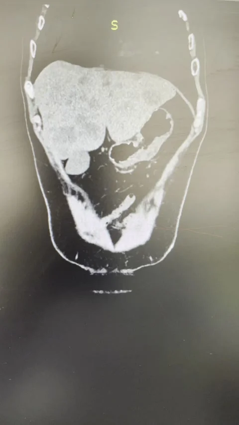 Multiple liver metastases on computed tomography scan, medical macro shot Vídeo Stock 164236900