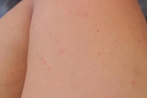 Multiple Mosquito Bite Marks on Skin Stock Photos