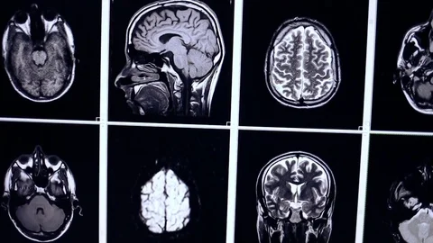 Multiple MRI brain scan Stock Footage 85320359