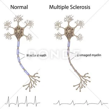 Multiple sclerosis Stock Illustration