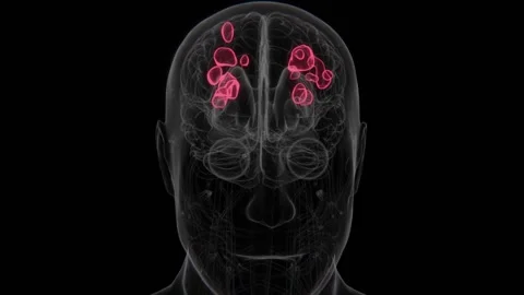 Multiple Sclerosis Indication in brain X-ray in HD Video | Multiple Sclerosis Stock Footage 330918646