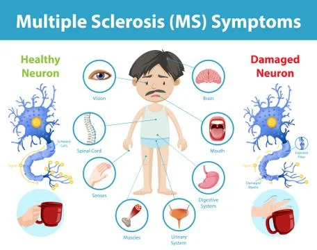 Multiple sclerosis (MS) symptoms information infographic Stock Illustration