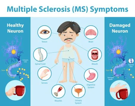 Multiple sclerosis (MS) symptoms information infographic Stock Illustration