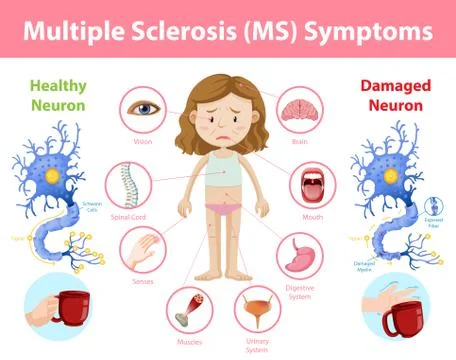 Multiple sclerosis (MS) symptoms information infographic Stock Illustration