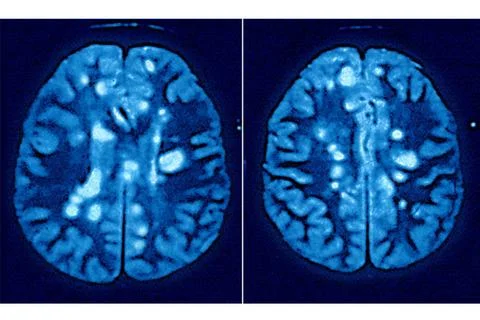  Multiple sclerosis, scan Myelin, the protective sheath covering nerve cel... Stock Photos