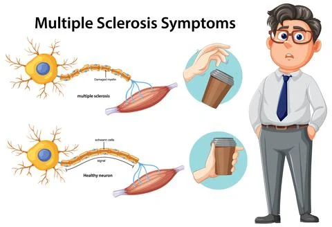 Multiple Sclerosis Symptoms and Neuron Damage Illustration Stock Illustration