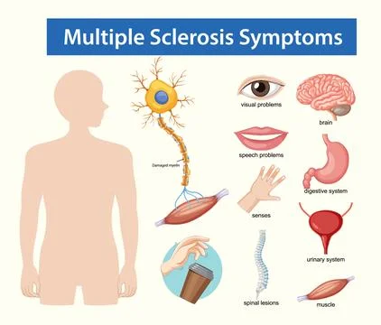 Multiple Sclerosis Symptoms Medical Vector Illustration Stock Illustration