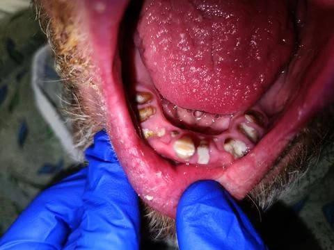 Multiple severely broken and carious mandibular teeth Stock Photos