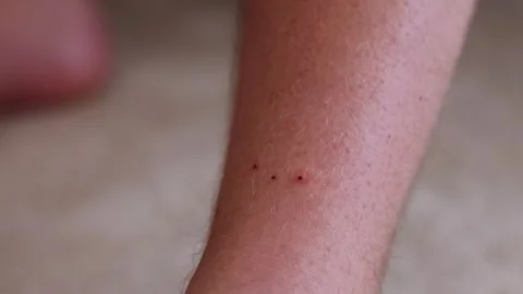 Multiple ticks lodged into a mans leg with the potential of transferring Lymes Stock Footage 310767860