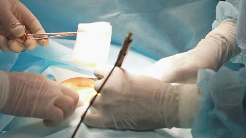 Multiracial doctors preparing to cut stomach during the surgery Stock Footage 114190593