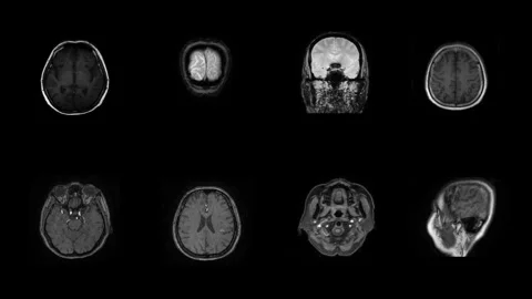 Multisection result of MRI human brain. Stock Footage 277620189