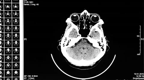Multispectral computed tomography of the head 1 Stock Footage 47163466