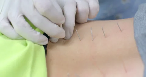 The muscles are very tense causing the needle to bend.A small needle. Stock Footage 286423507