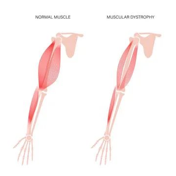 Muscular dystrophy of arm Stock Illustration