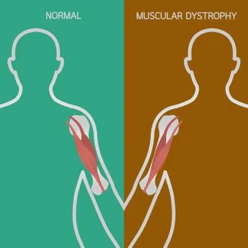 Muscular dystrophy vector illustration Stock Illustration