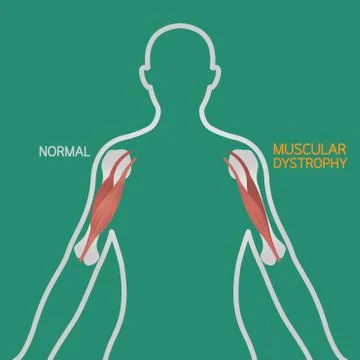 Muscular dystrophy vector illustration Stock Illustration