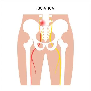 Muscular pelvis sciatica Stock Illustration