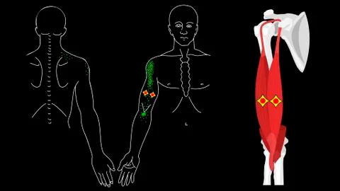 Musculus biceps brachii. Biceps trigger points and pain Stock Illustration