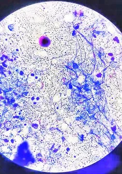 Mycobacterium pus sample. Microscopic view. Ziehl Neelsen stain. Stock Photos