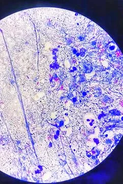 Mycobacterium pus sample. Microscopic view. Ziehl Neelsen stain. Stock Photos