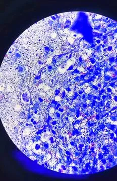Mycobacterium pus sample. Microscopic view. Ziehl Neelsen stain. Stock Photos